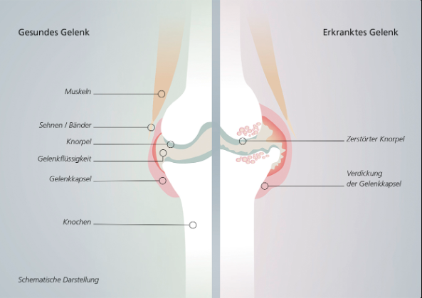 Arthrose schematische Darstellung